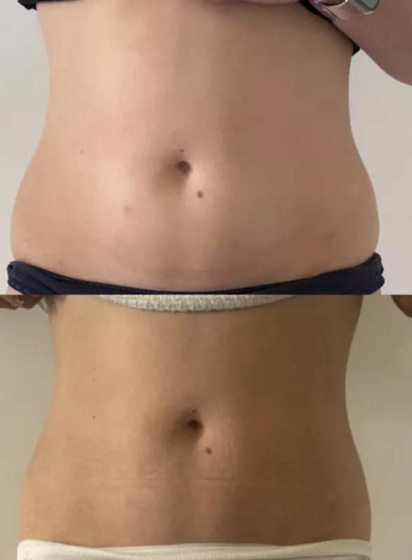 Traitement de la cellulite par radiofréquence et cavitation, Veauche, Kyroma Institut