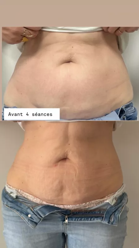 Traitement de la cellulite par radiofréquence et cavitation, Veauche, Kyroma Institut