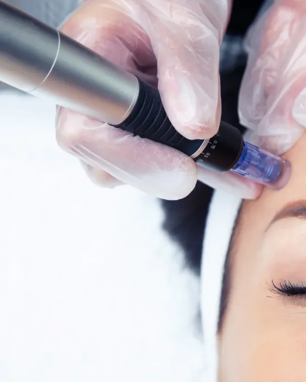 Microneedling Mesoestetic– éclat & cicatrices chez Kyroma, institut votre centre de beauté à Veauche, Veauche, Kyroma Institut